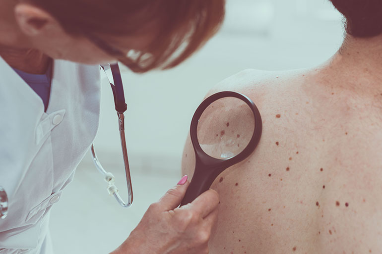 Everything You Need to Know About Melanoma